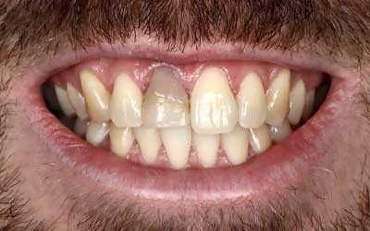 Root Canal And Porcelain Crown 1 Before Web