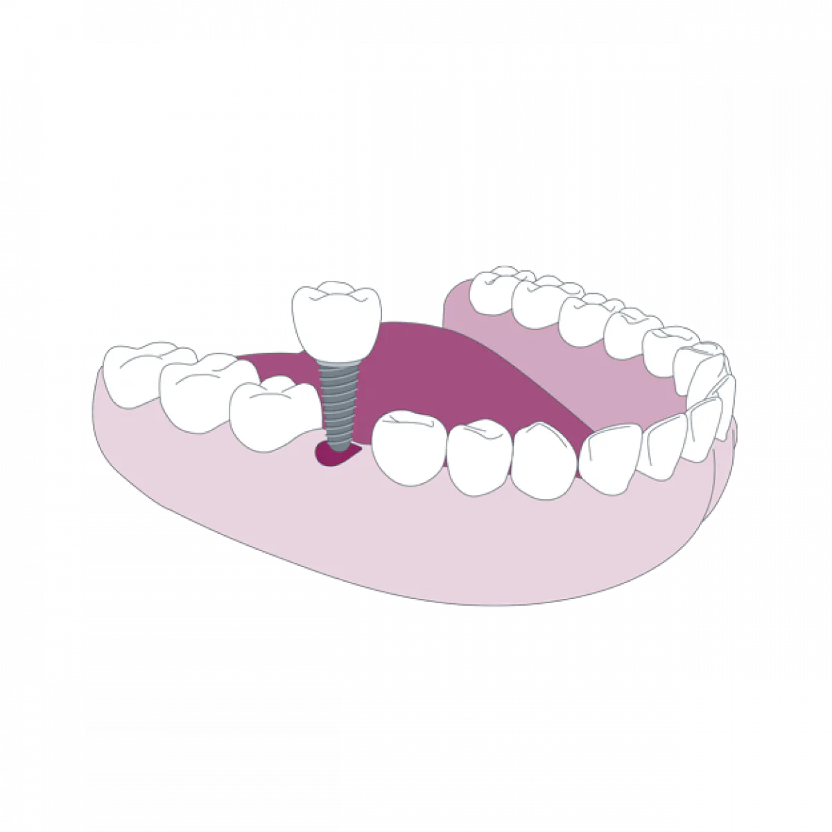 Sced Single Dental Implant Illustration Small Glasgow