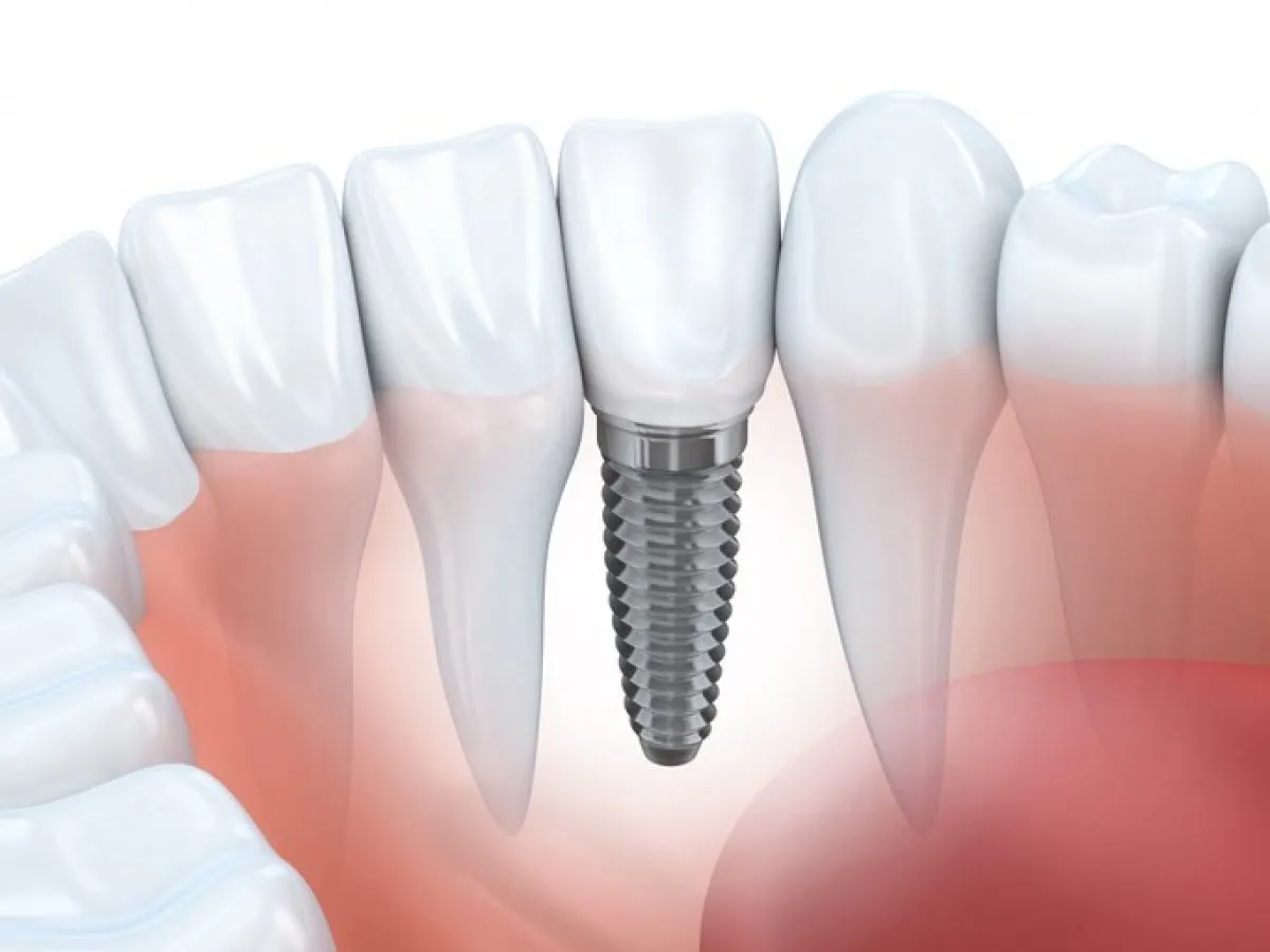 Single Implant Rainham Image