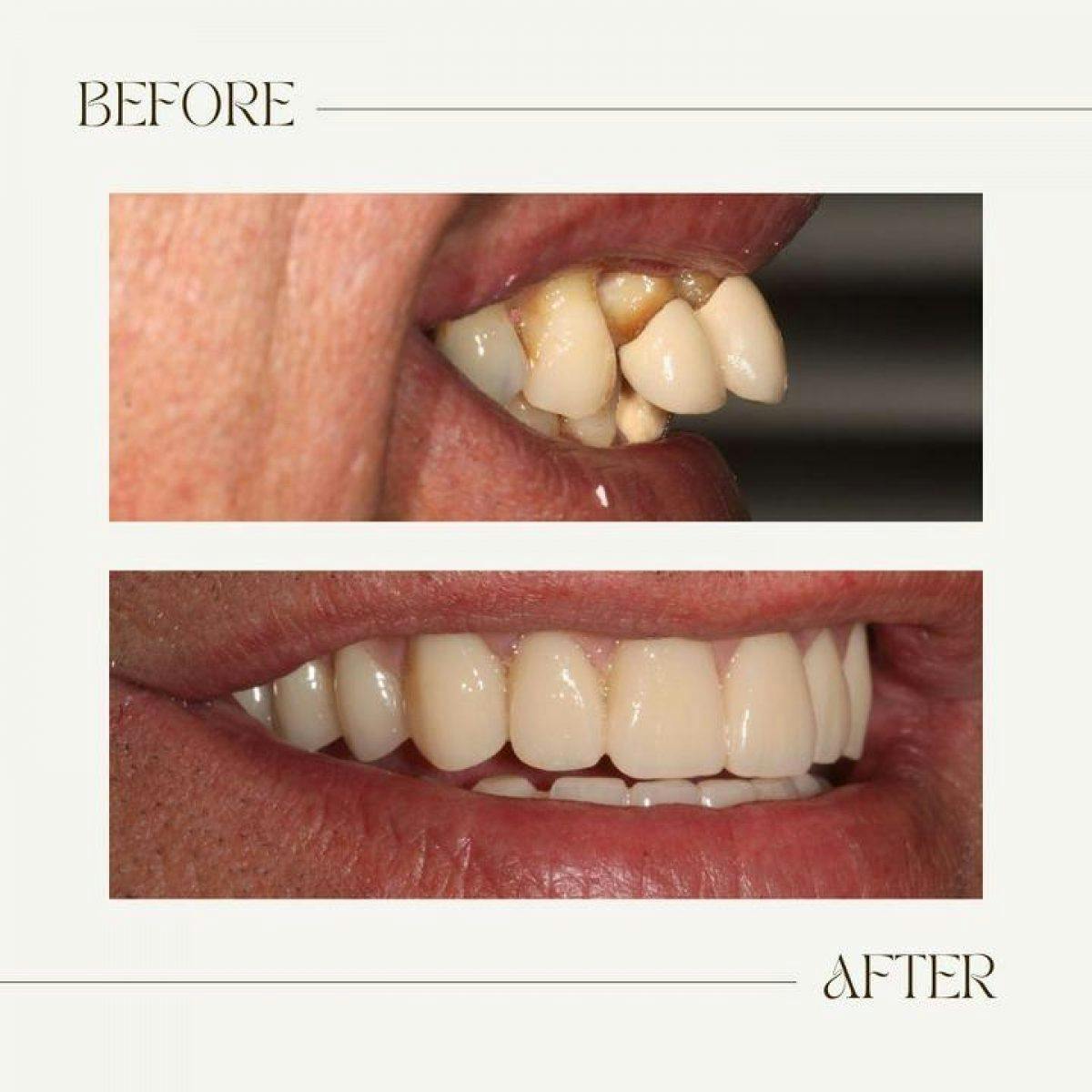 Before And After Photographs Portman Dental Care 2