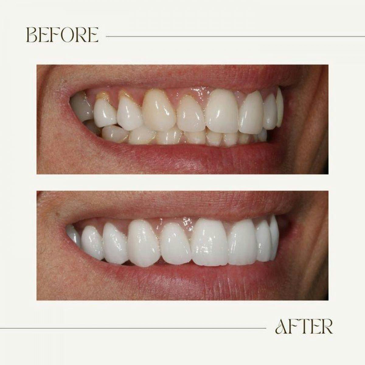 Before And After Photographs Portman Dental Care 3