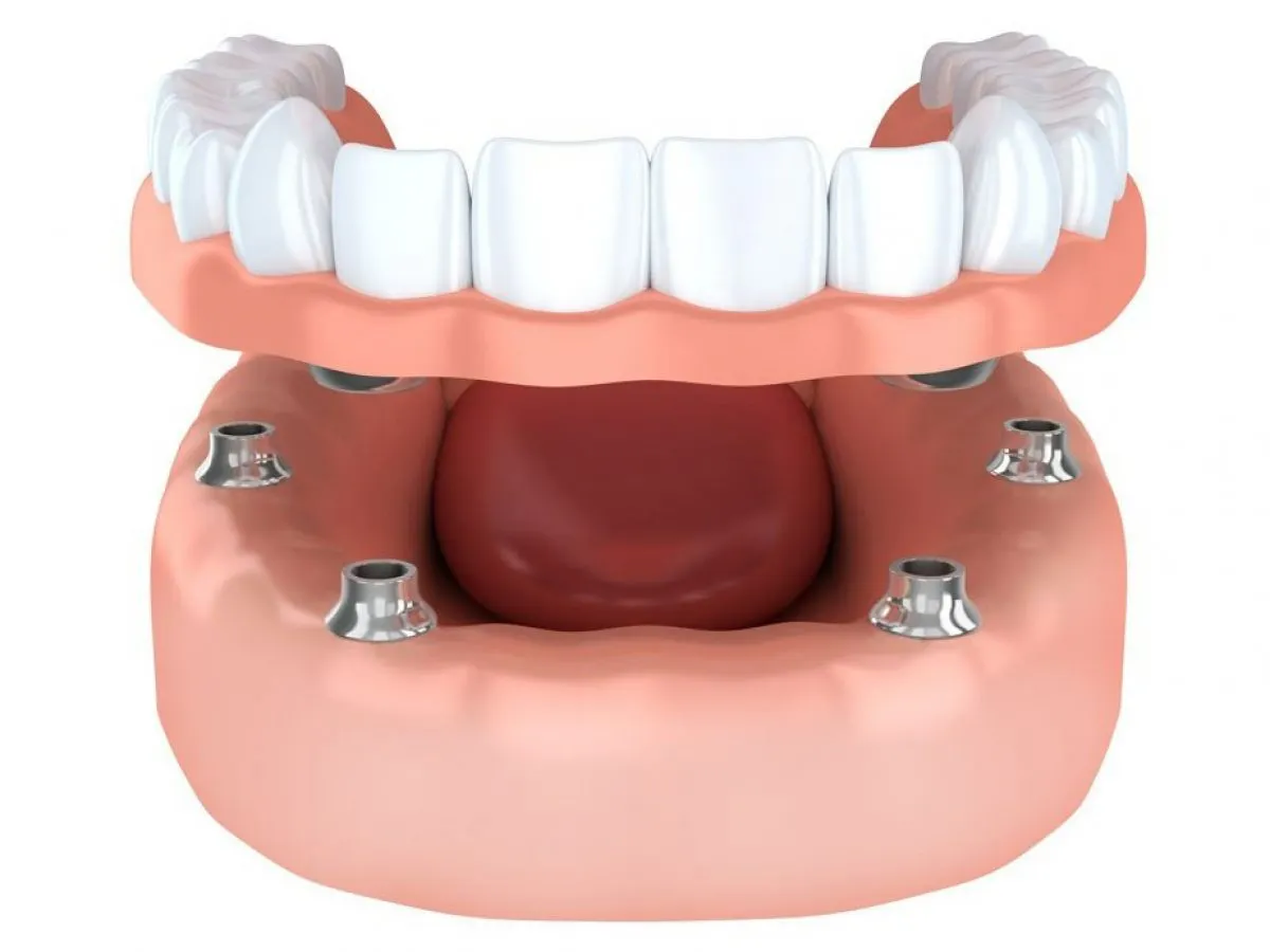Implant secured dentures