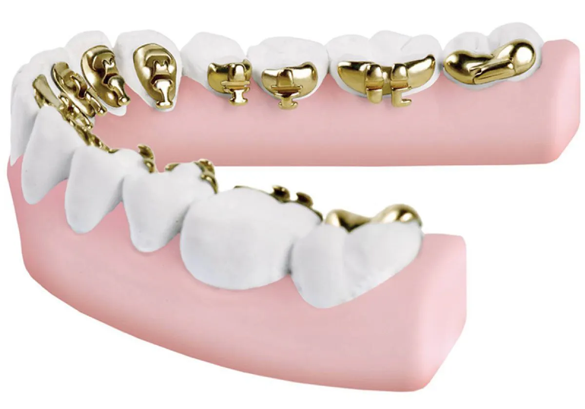 Lingual Braces Model