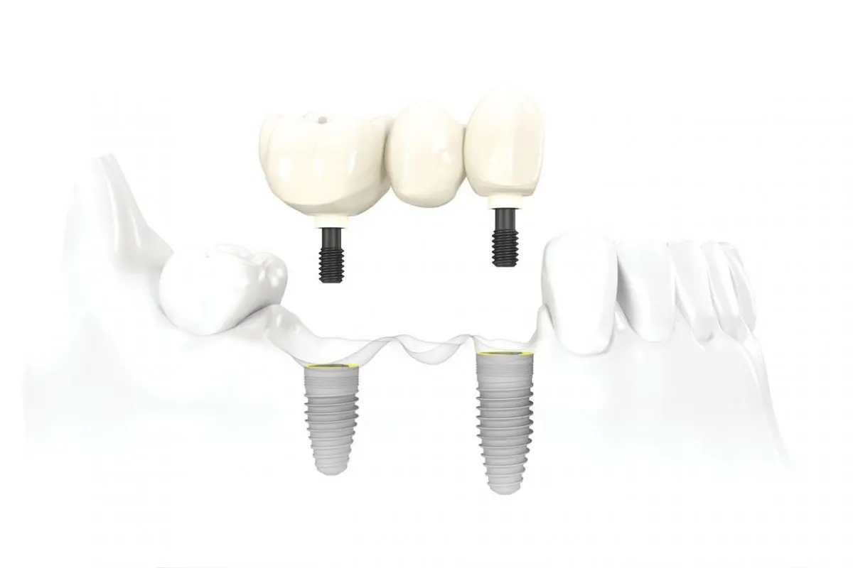 Multiple Dental Implants Dental Academy