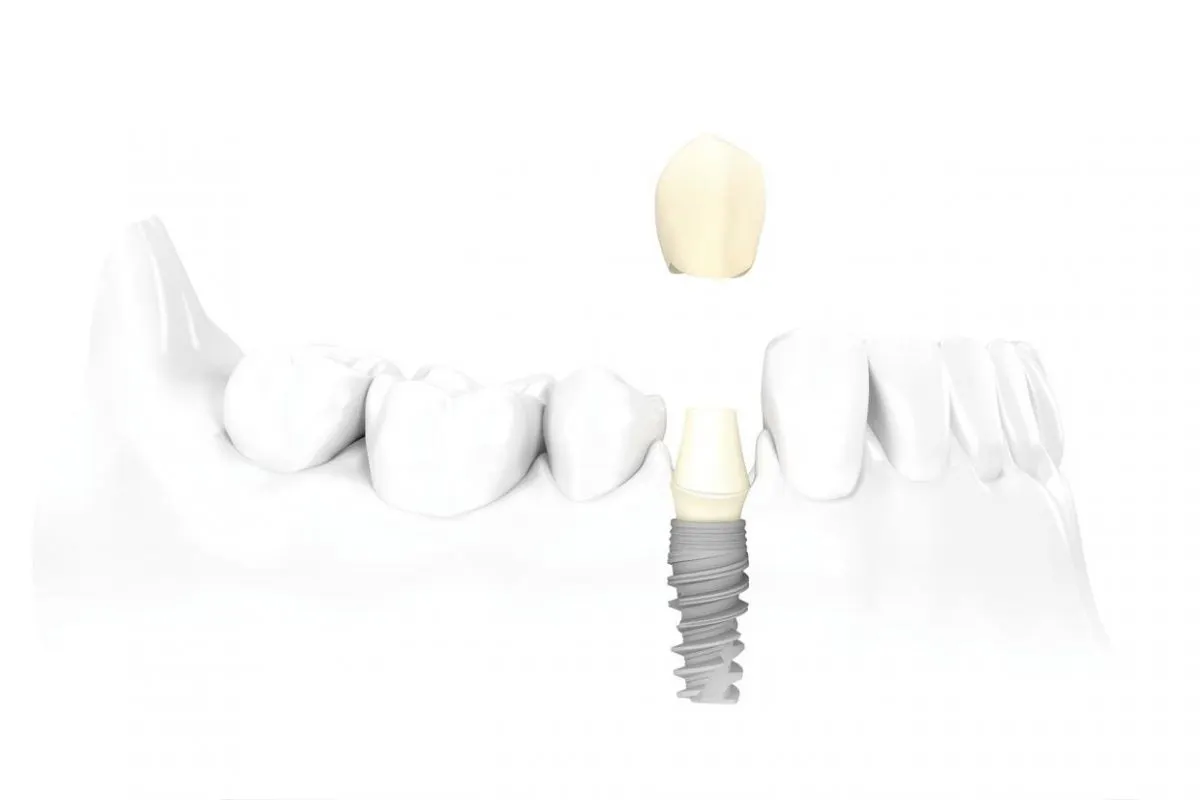 Single Dental Implants Dental Academy