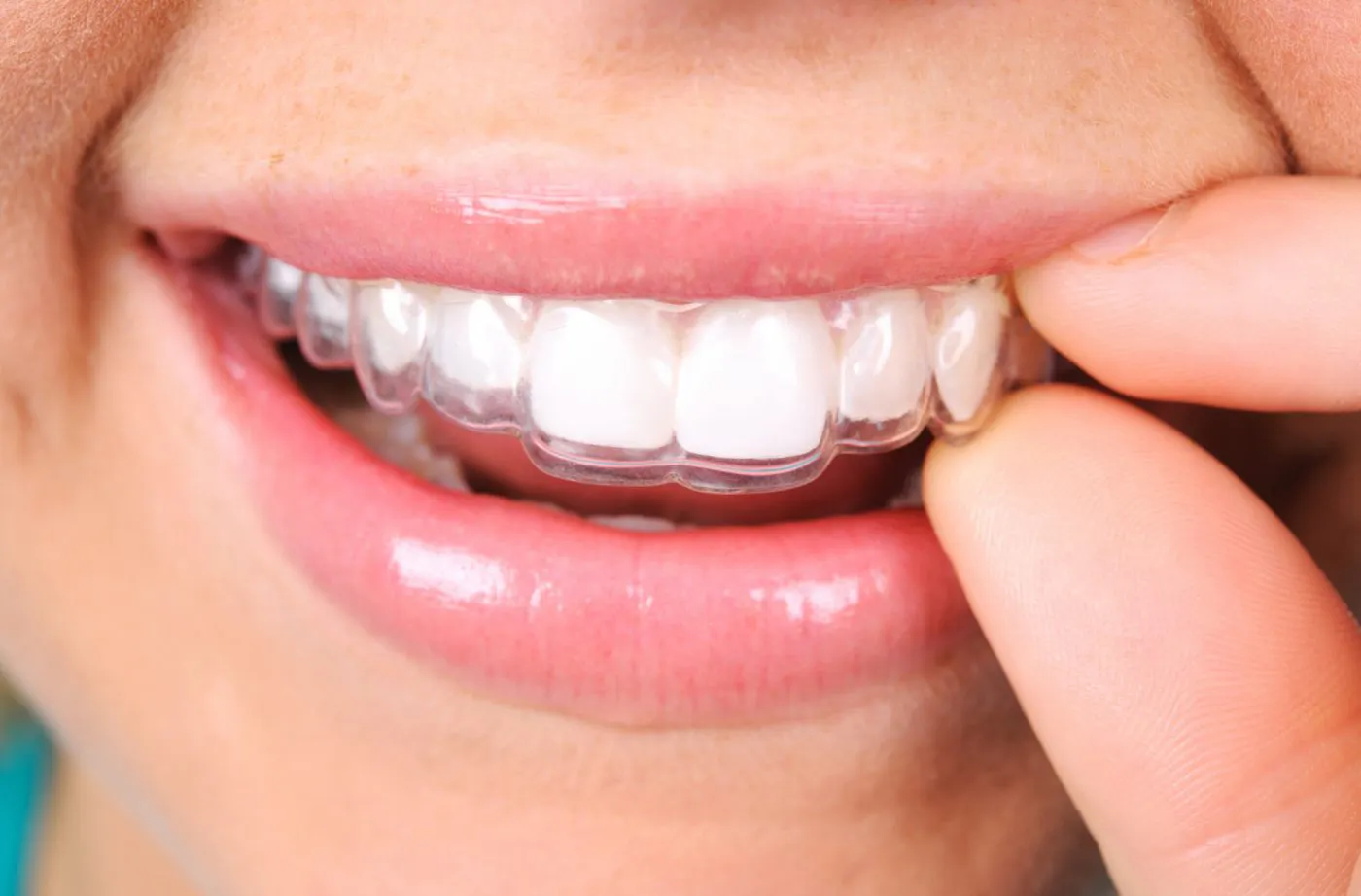 Invisalign 1211