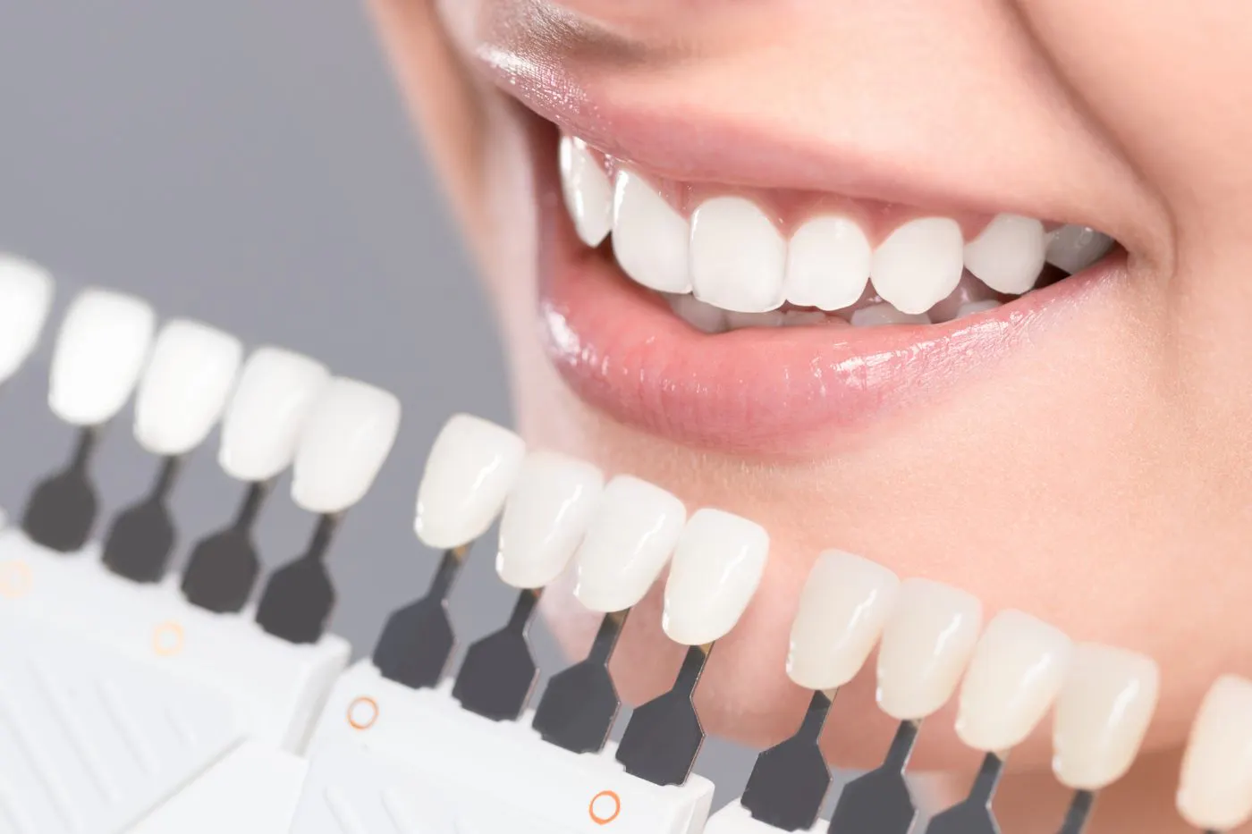Teeth Whitening 2
