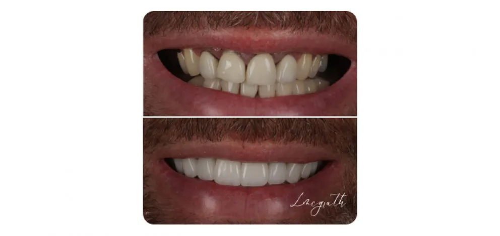 Pmcg Lmsg Complex Restorative3A