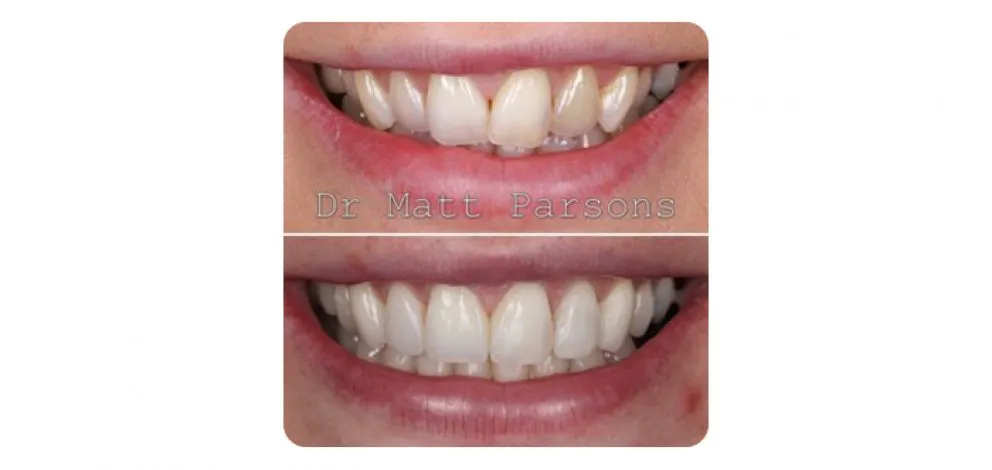 Pmcg Mpsg Comp Bond Case 4A