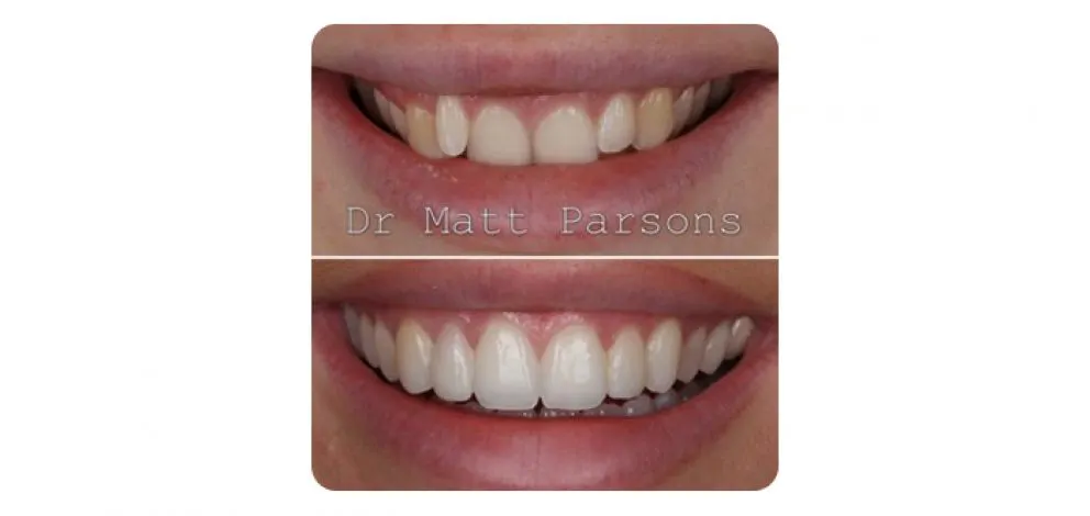 Pmcg Mpsg Comp Bond Case 4B