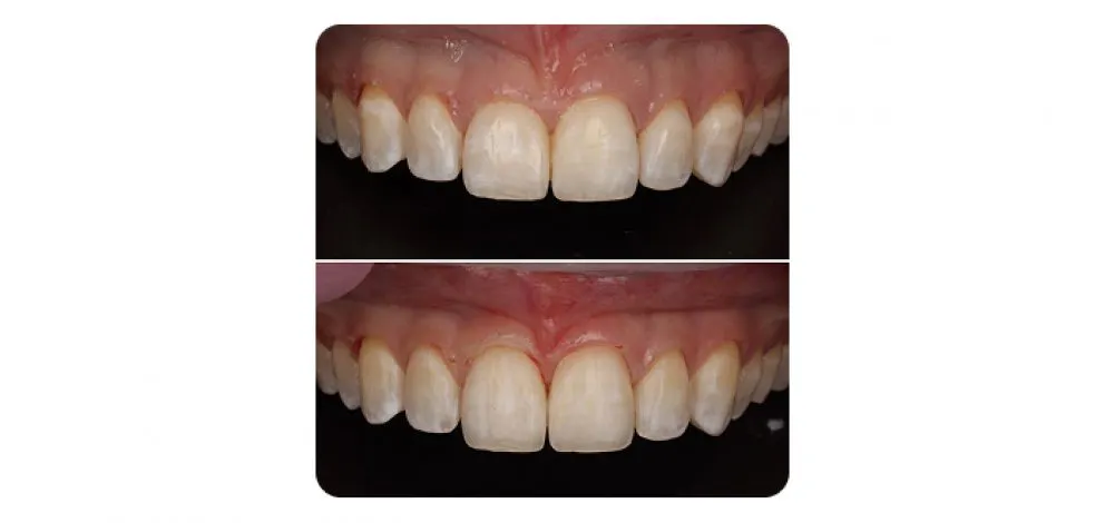 Pmcg Mpsg Porc Veneers Case 1B