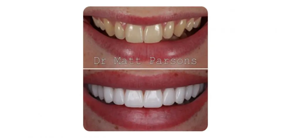 Pmcg Mpsg Porc Veneers Case 5A