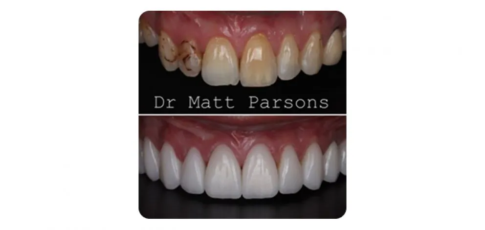 Pmcg Mpsg Porc Veneers Case 5B