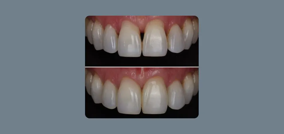 Pmcg Parsons Composite Bonding Case1 Photo1