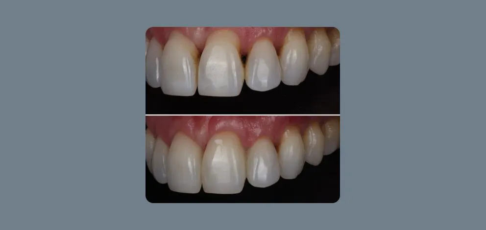 Pmcg Parsons Composite Bonding Case1 Photo2