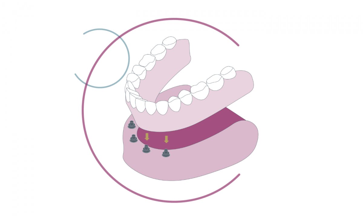 Implant Secured Denture