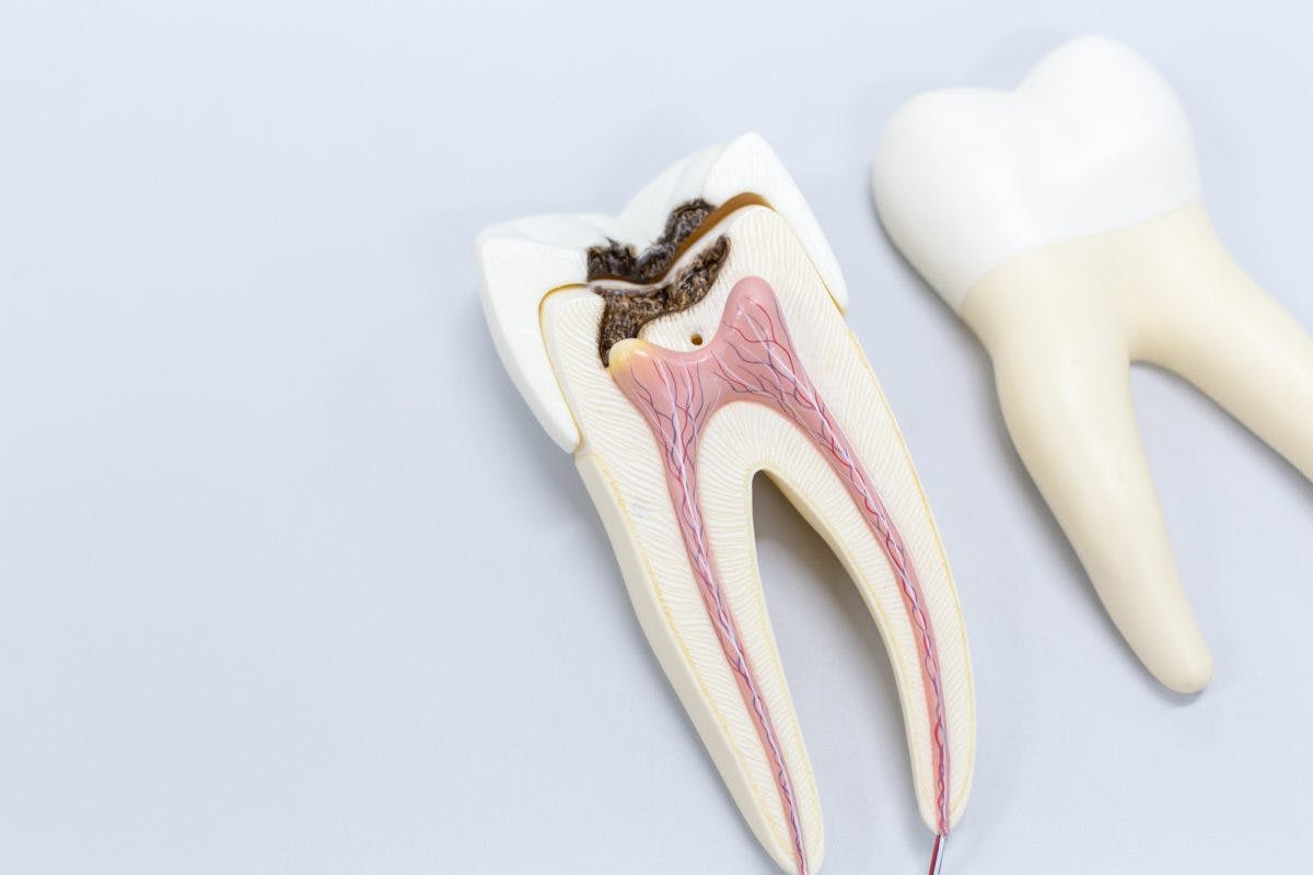 Root Canal Tooth Treatment