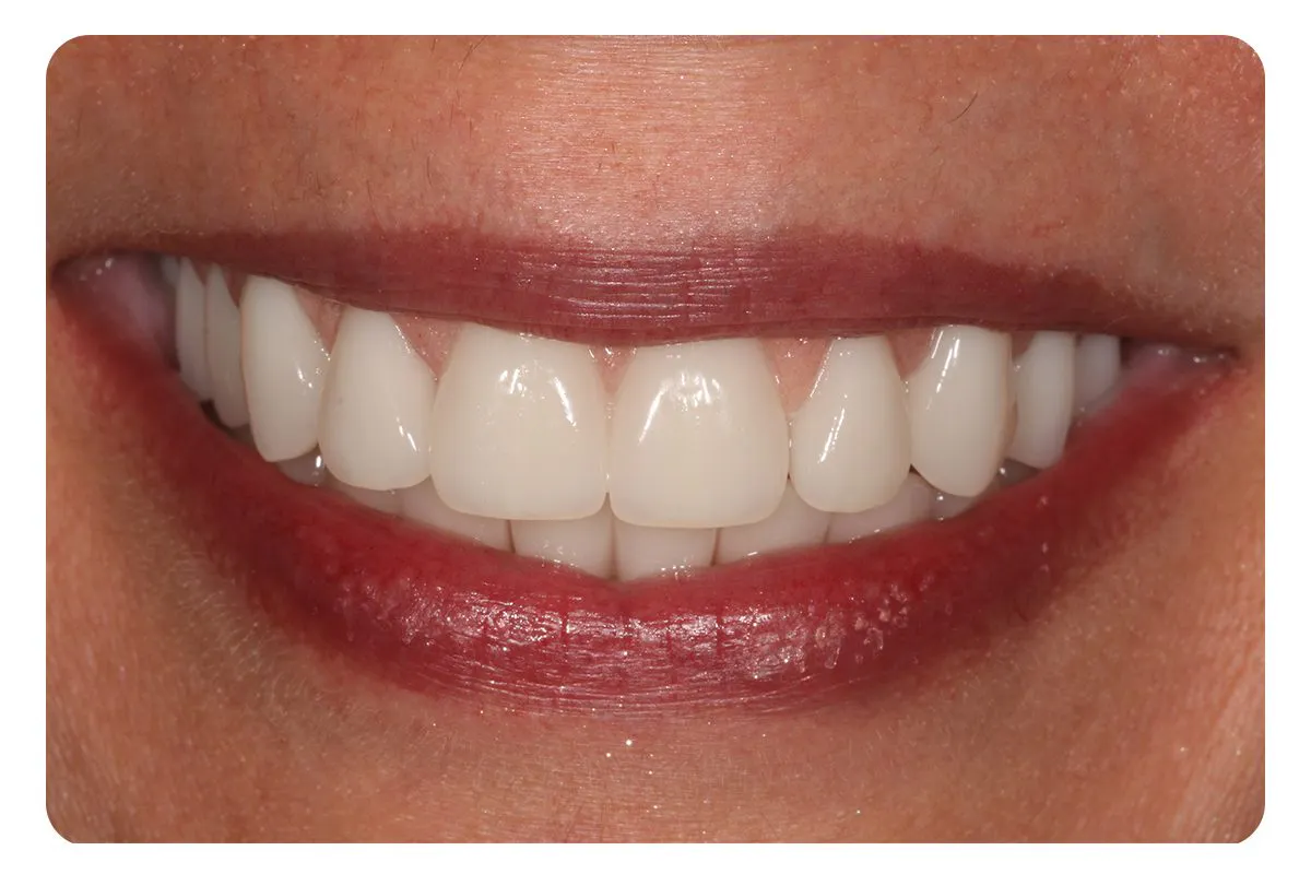 Patient After Same Day Teeth