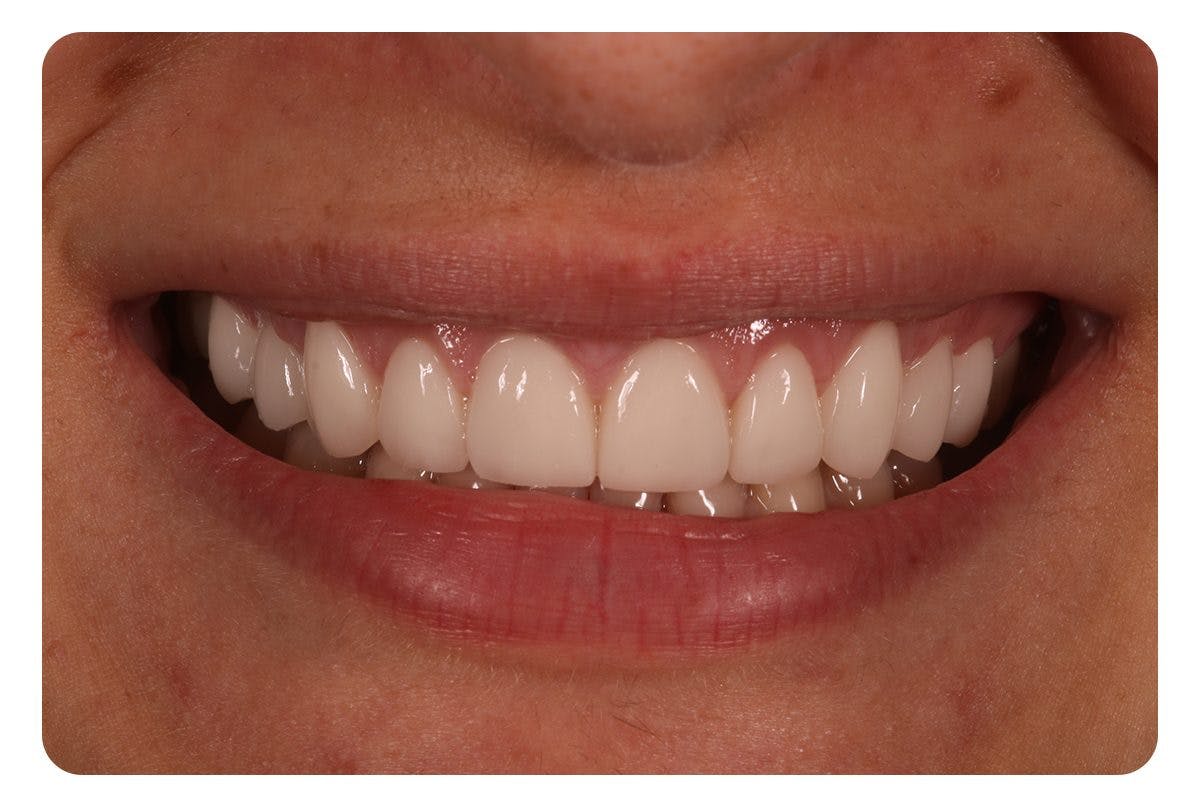 Patient After Teeth Repairs Crown 1