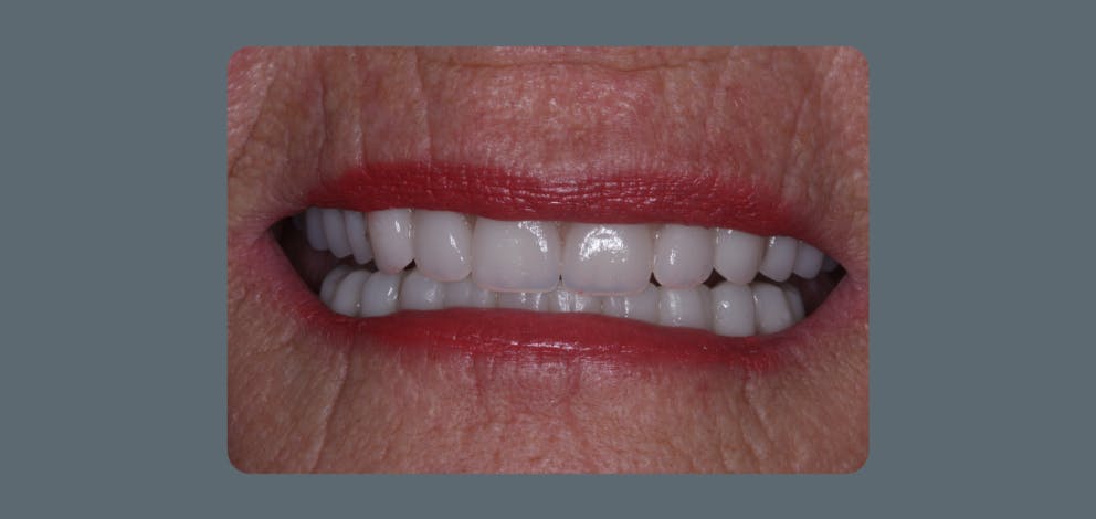 Implant Secured Dentures 1