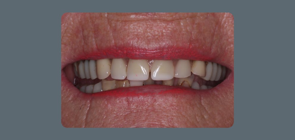 Implant Secured Dentures 2