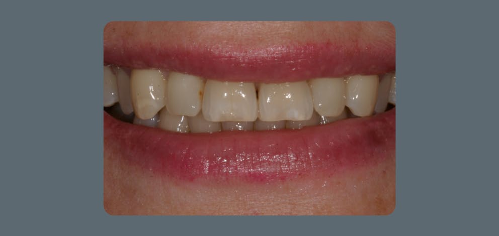 Patient 1 Teeth Whitening 1