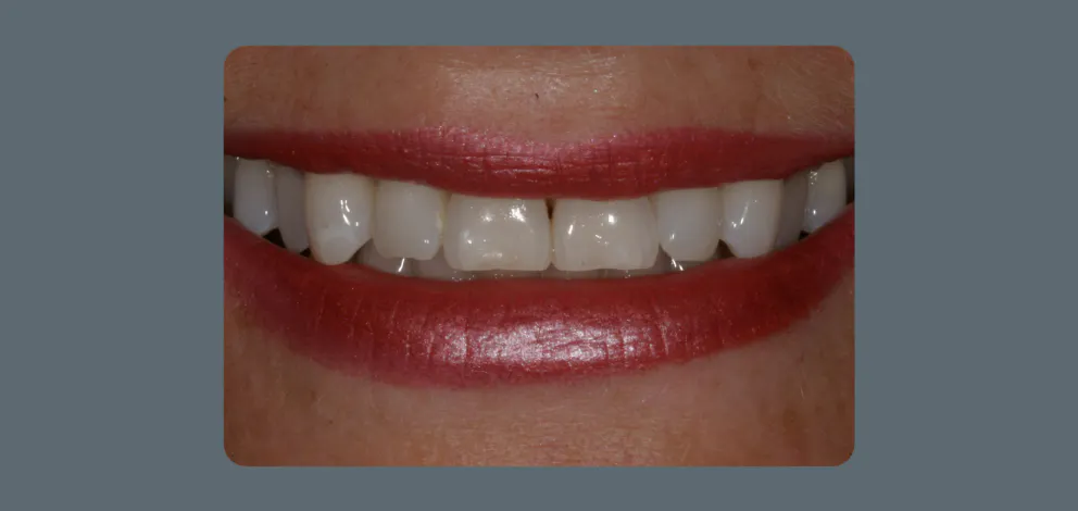 Patient 1 Teeth Whitening 2