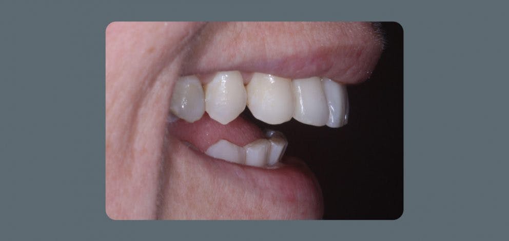 Teeth Straightening After
