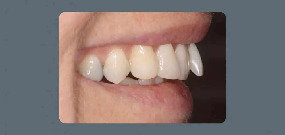 Teeth Straightening Before