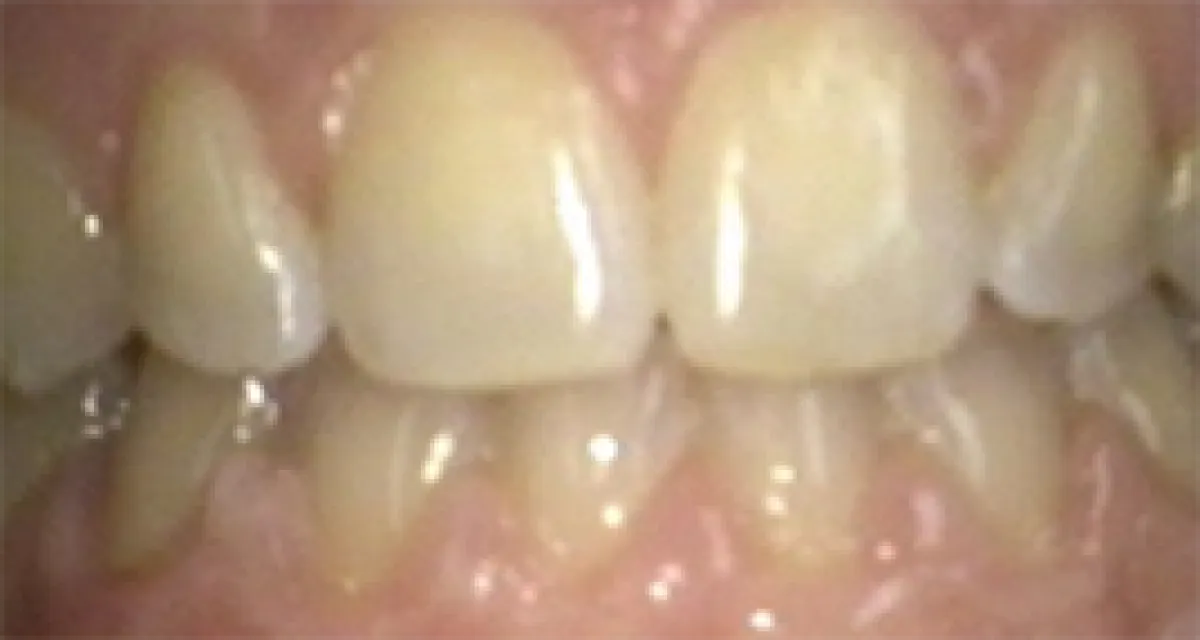 After Before Fast Braces Example 1