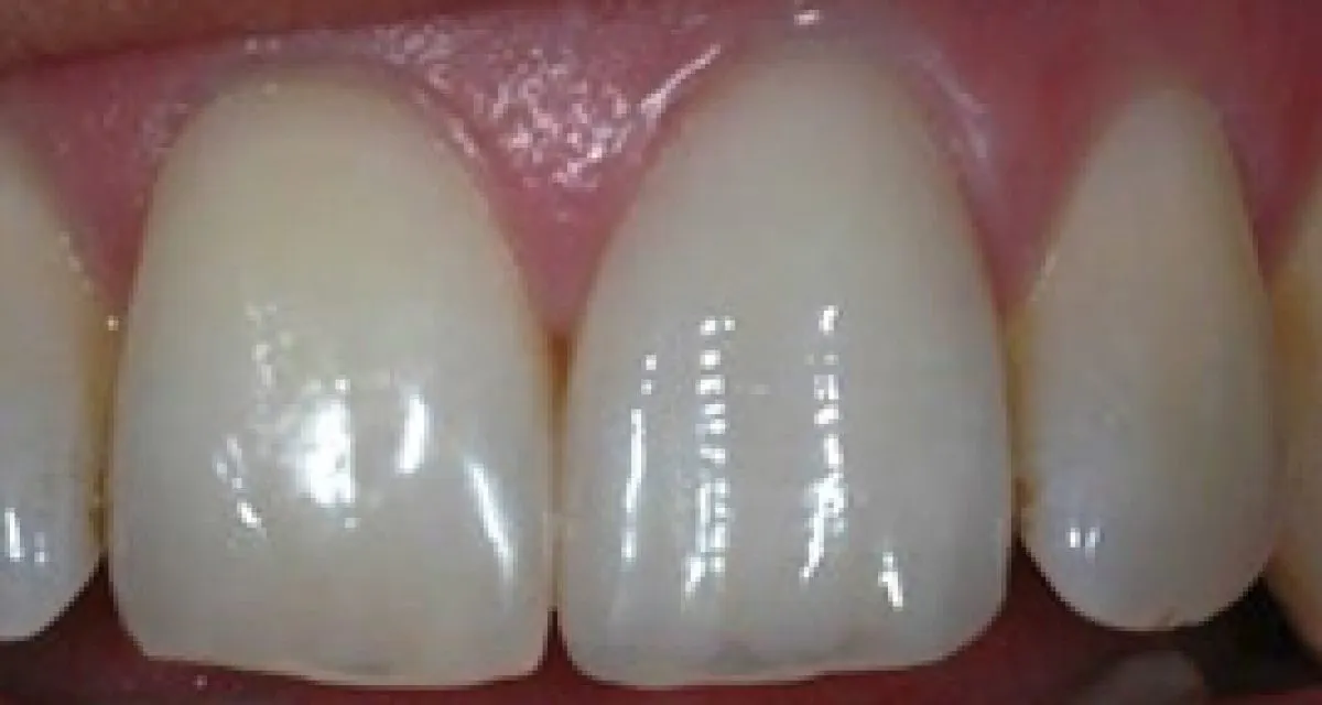 After Ceramic Crowns