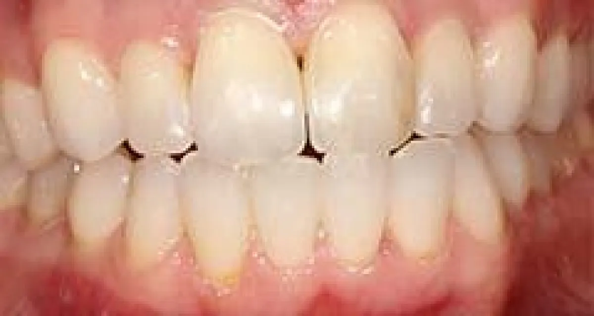 After Complex Cosmetic Tooth Alignment