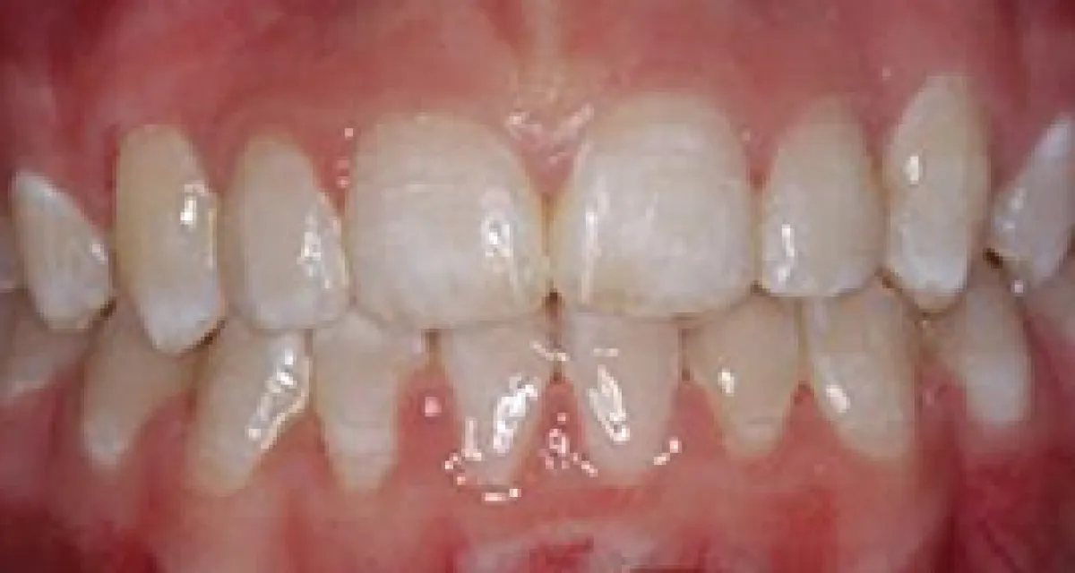 After Fast Braces Example 2