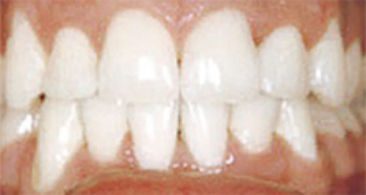After Fast Braces Example 3