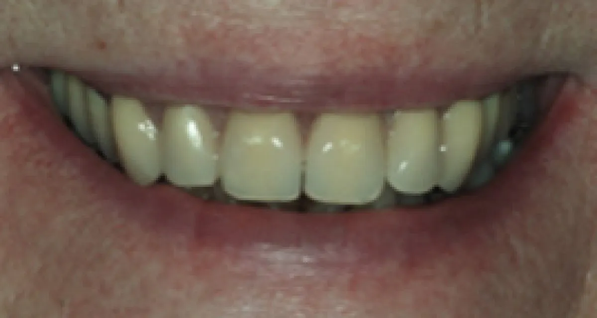 After Implant Retained Denture