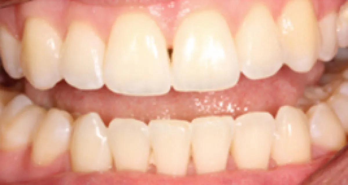 After Simple Cosmetic Tooth Alignment
