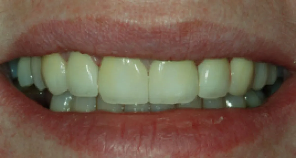 After Veneers Gaps And Chips