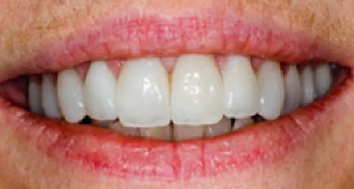 After Veneers Multiple Teeth