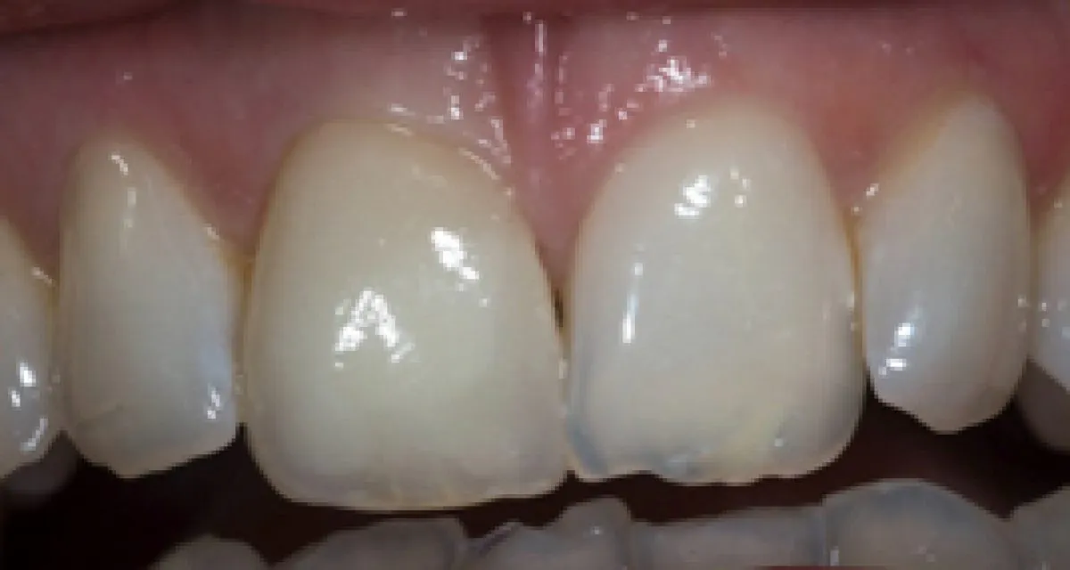 After Veneers Single Tooth