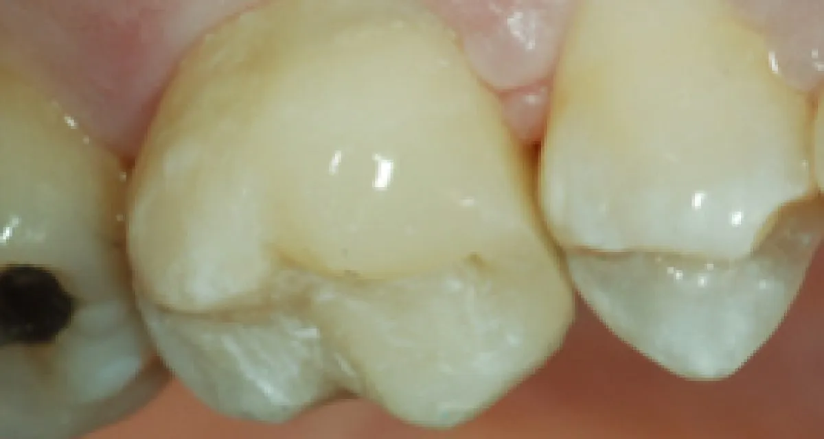 After White Fillings