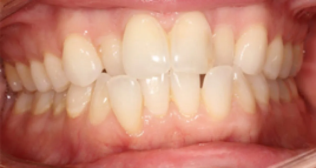 Before Complex Cosmetic Tooth Alignment