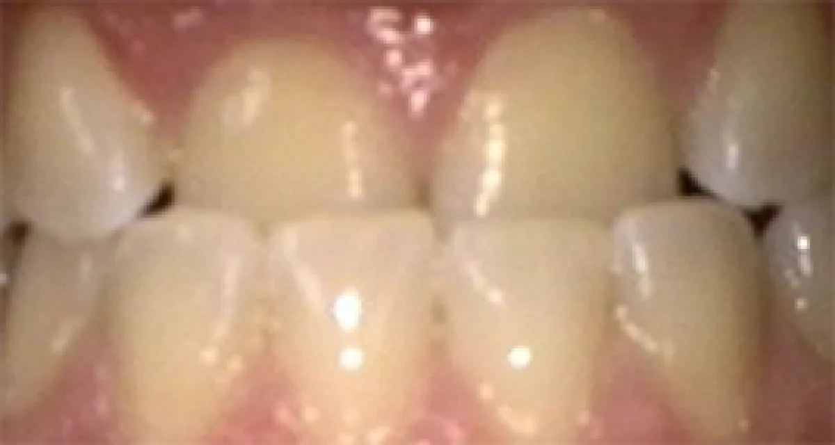 Before Fast Braces Example 1