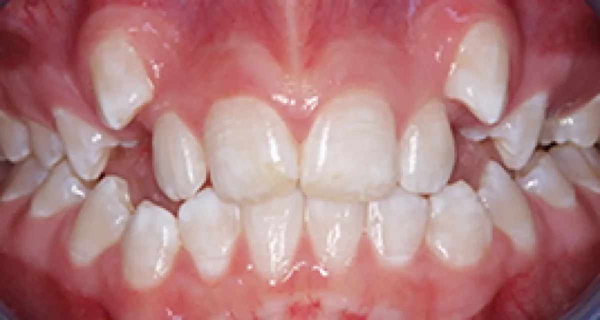 Before Fast Braces Example 2