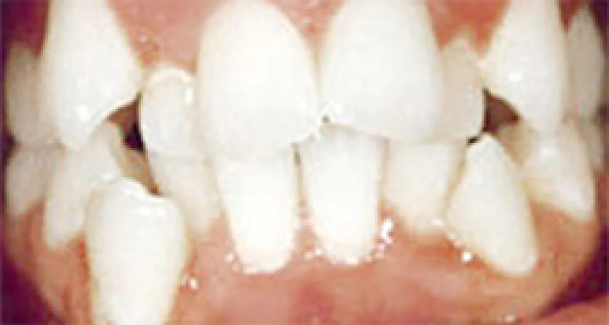 Before Fast Braces Example 3