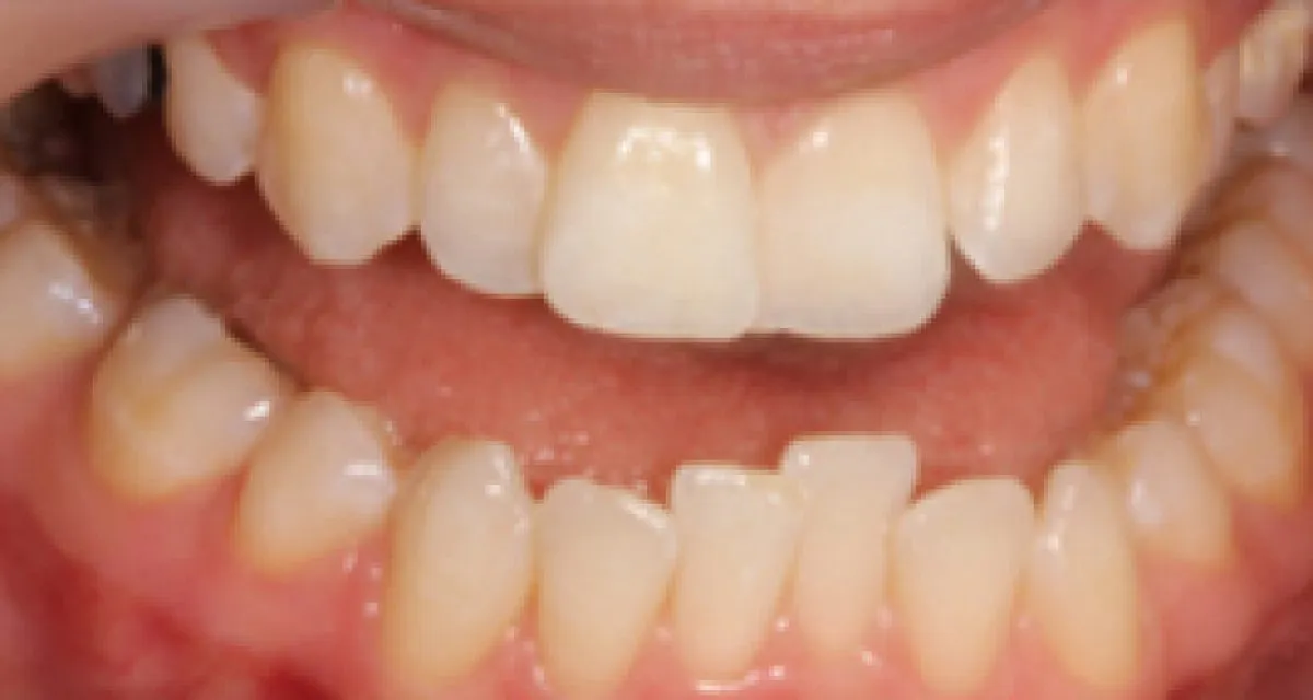 Before Simple Cosmetic Tooth Alignment