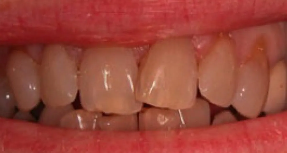 Before Veneers Multiple Teeth