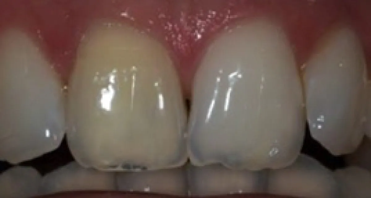 Before Veneers Single Tooth