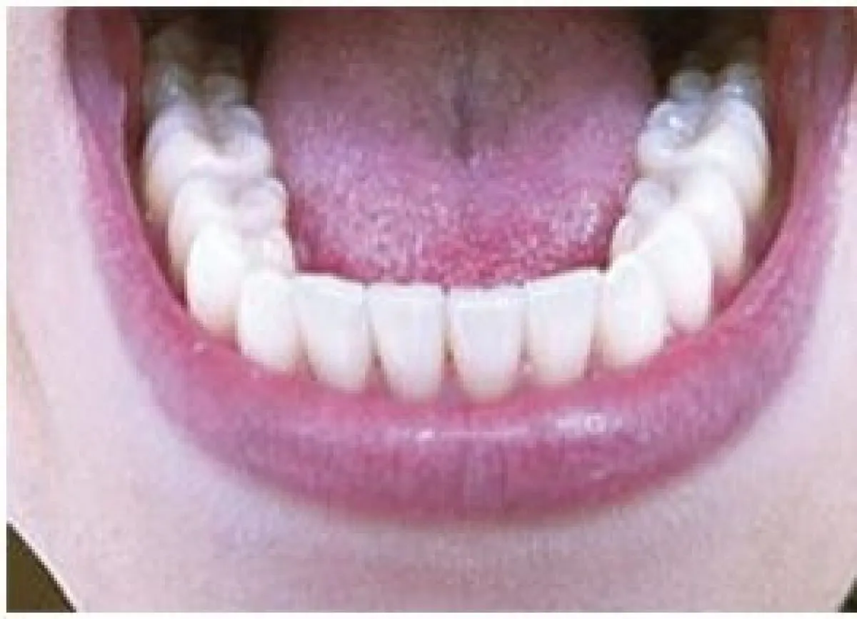 Clear Aligners 01 After