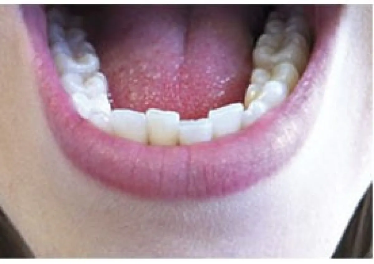 Clear Aligners 01