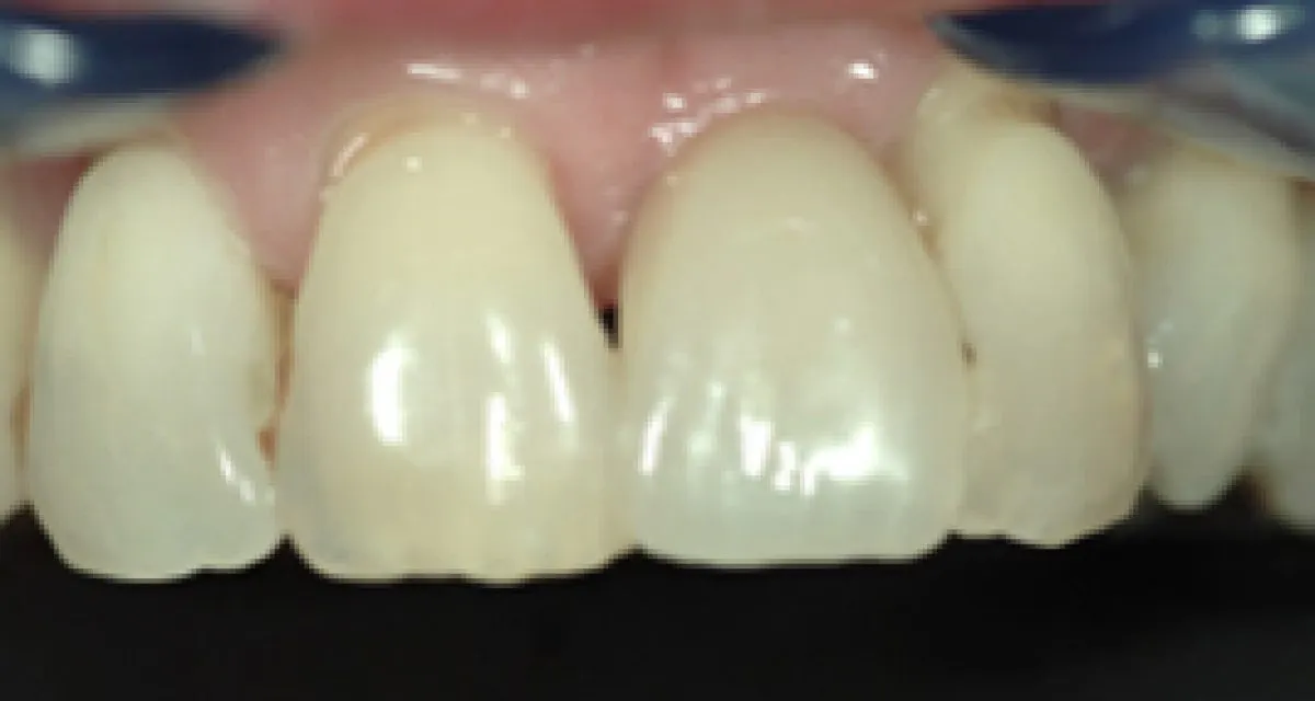 Implant Crowns After Whitehall